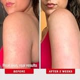 First Aid Beauty KP Bump Eraser Body Scrub Exfoliant with 10% AHA Chemical Exfoliation