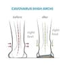 Arches Insoles Type 3 Full-Length Orthotics for Supination and High Arches