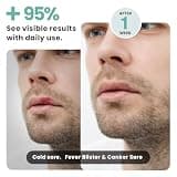 Luminance RED Face & Cold Sore Therapy Device with FSA/HSA Eligibility