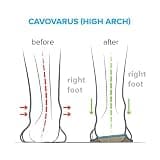Arches Insoles Type 3 Full-Length Orthotics for Supination and High Arches